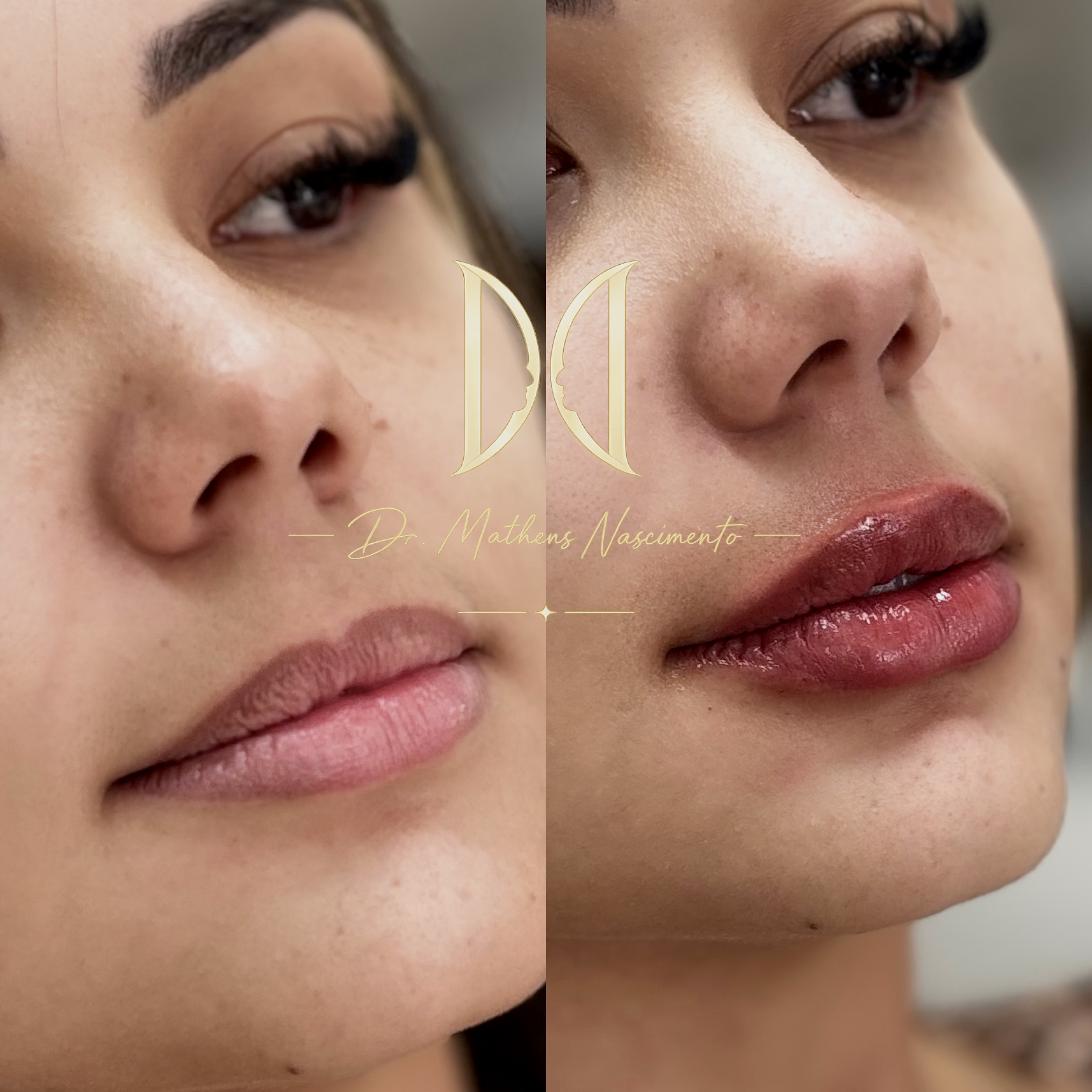 Natural Lips - Preenchimento Premium