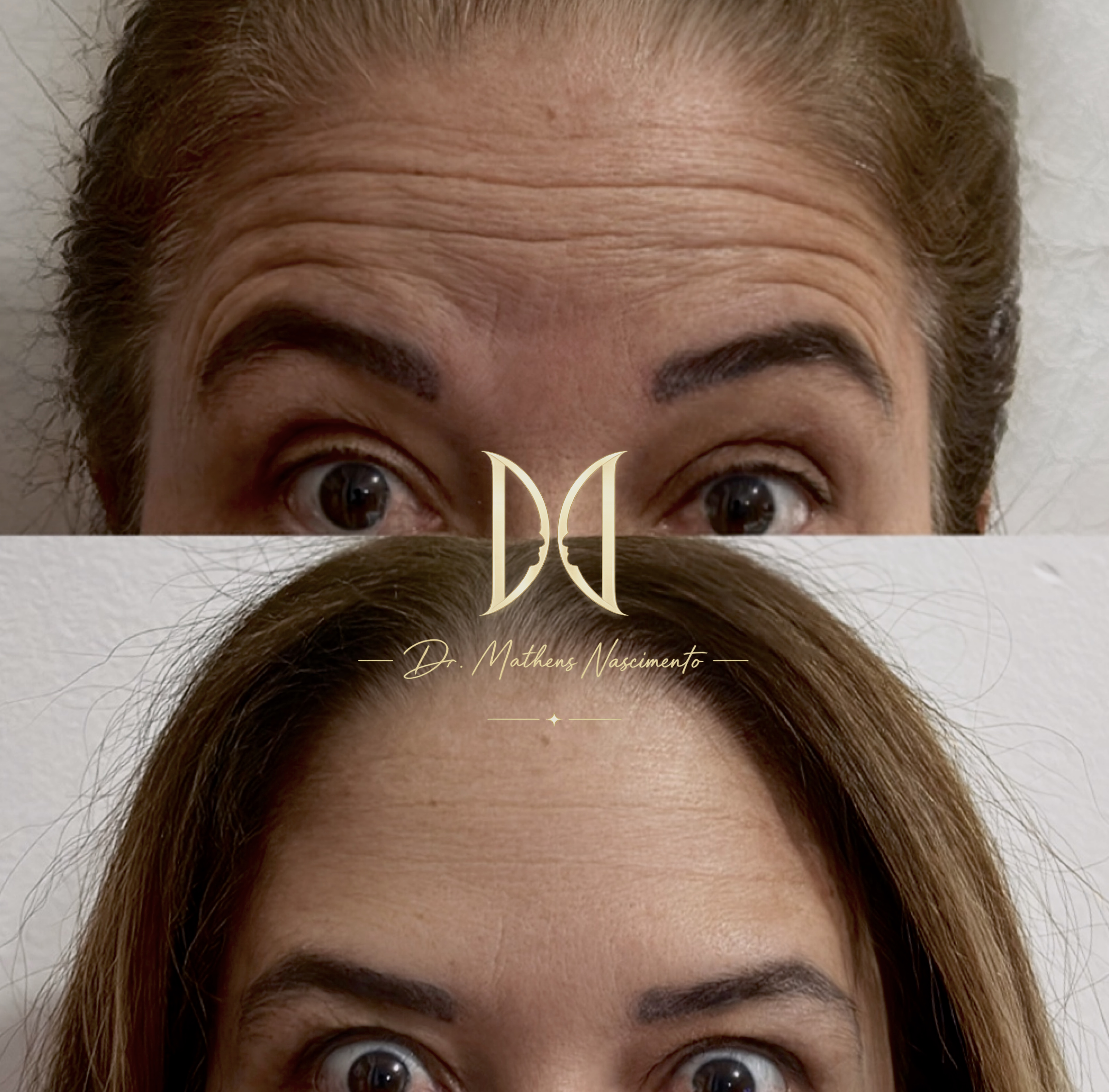 Botox Full - Técnica Autoral