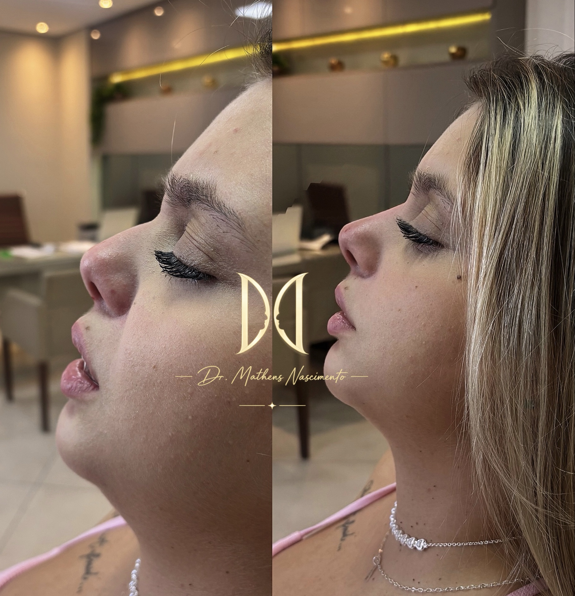 Remodelação de Nariz - Harmonia Facial